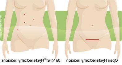 hysterectomy incision comparison